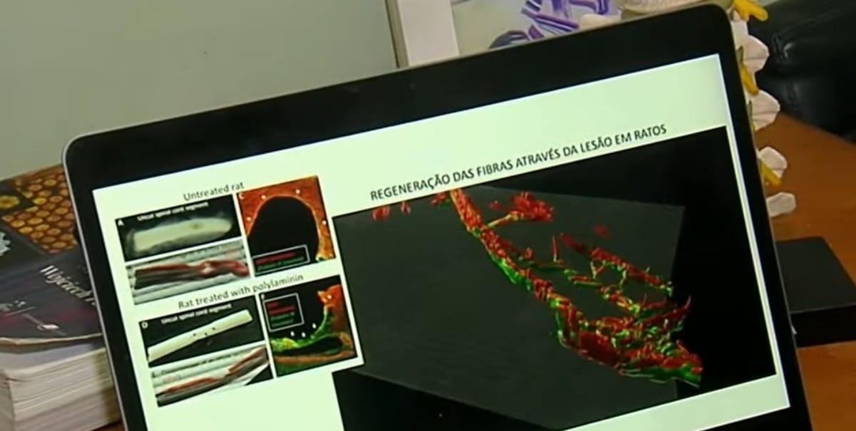 Polilaminina: substância da placenta traz avanços em casos de paralisia