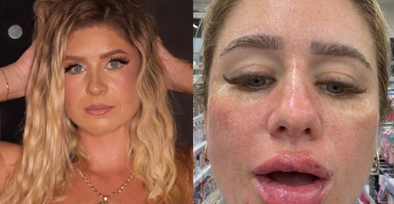 Influenciadora passa sufoco com Face ID após procedimentos faciais e compartilha relato: 'Rosto completamente diferente'