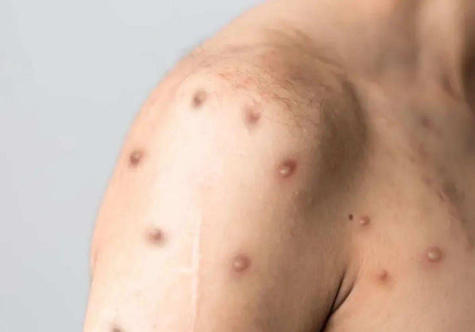 Rio Preto confirma primeiro caso de Mpox em 2026, diz prefeitura | G1