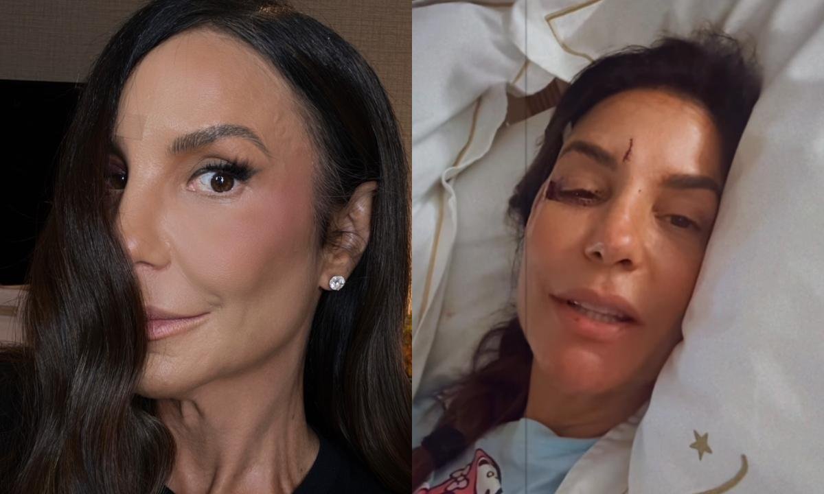 Ivete Sangalo mostra hematoma no rosto após acidente
