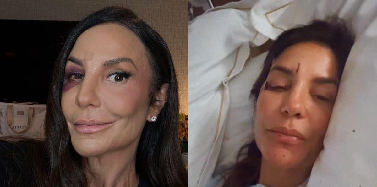 Ivete Sangalo passa por cirurgia de 7 horas após fratura na mandíbula
