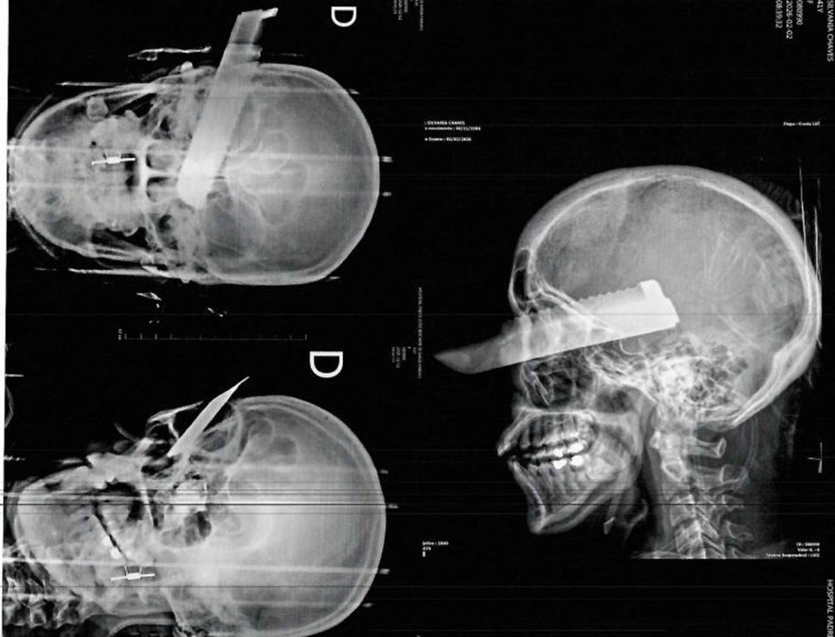 Mulher fica com faca presa no olho ao escapar de feminicídio | G1