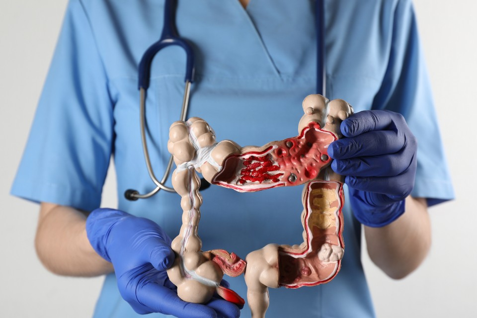 Não importa a sua idade, não ignore esses sintomas do câncer de intestino (que vão além do sangue nas fezes), alertam cirurgiões