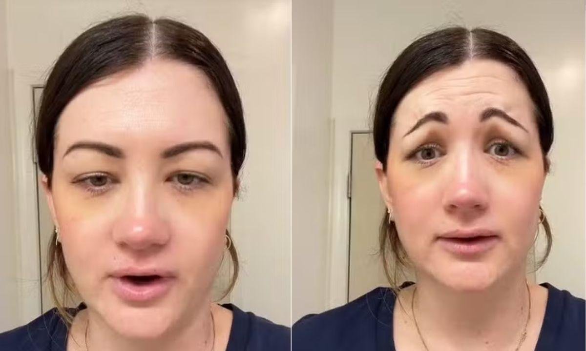 Botox de R$ 2.700 dá errado e mulher fica com cara de "palhaço triste"