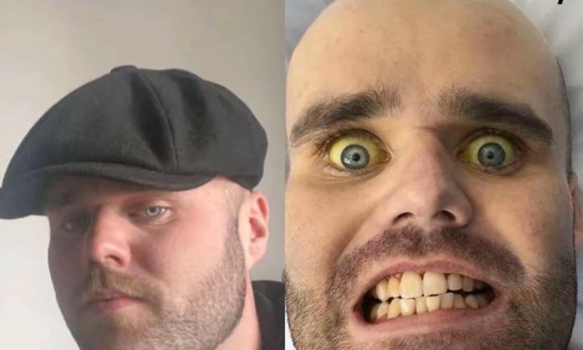 Vício em álcool deixa homem com pele e olhos amarelados