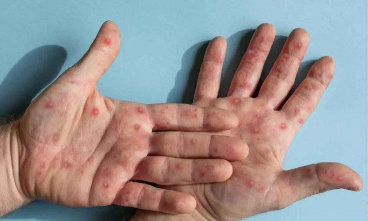Mpox: SP registra novo caso e paciente cumpre quarentena em casa