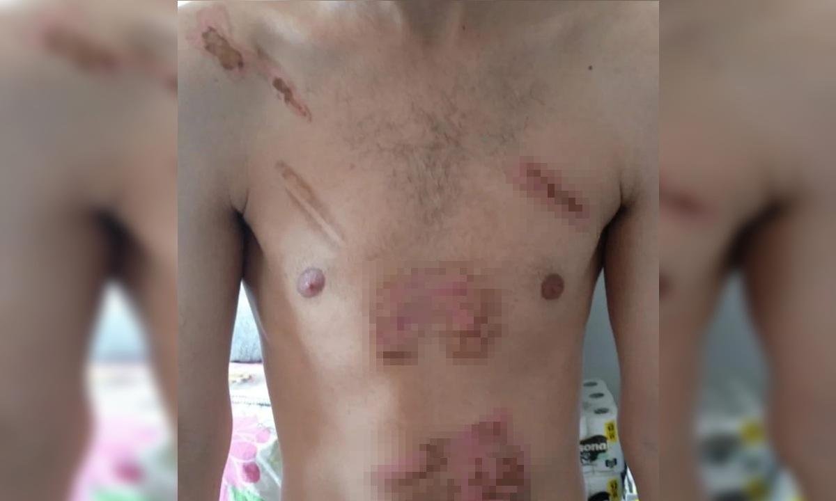 Jovem é torturado, queimado com ferro e chapinha de cabelo por mulher
