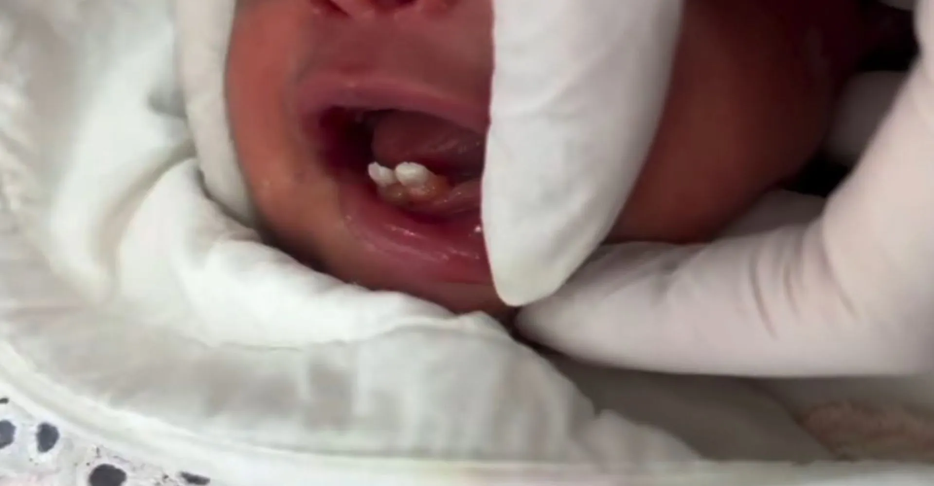 Bebê nasce com dentes e passa por cirurgia aos 6 dias em Vitória | G1