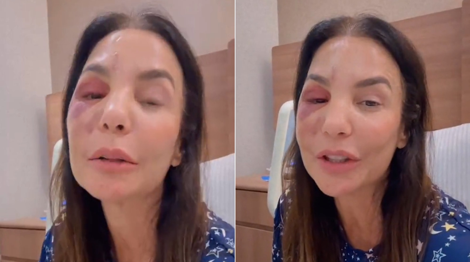 Após queda, Ivete Sangalo passa por cirurgia no rosto, mas tranquiliza fãs: 'Esse inchaço é natural'