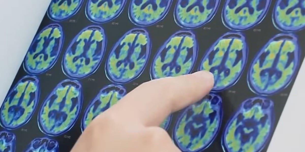 Anvisa aprova Lecanemabe, novo medicamento para tratamento de Alzheimer