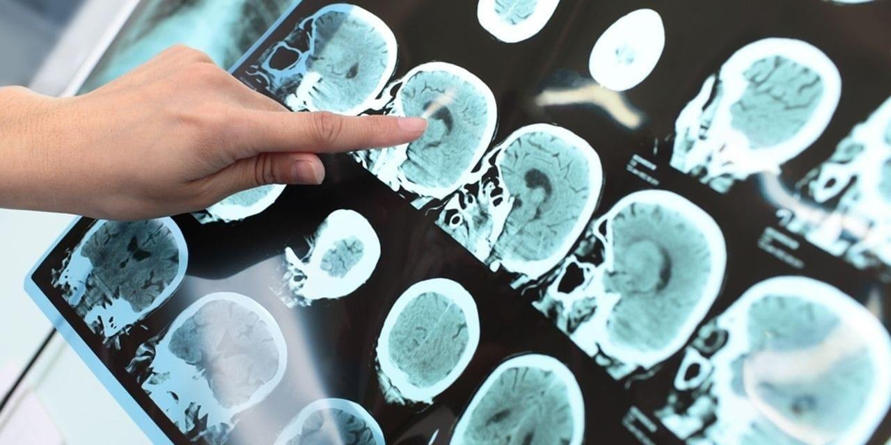 Leqembi: como funciona o novo medicamento contra o Alzheimer