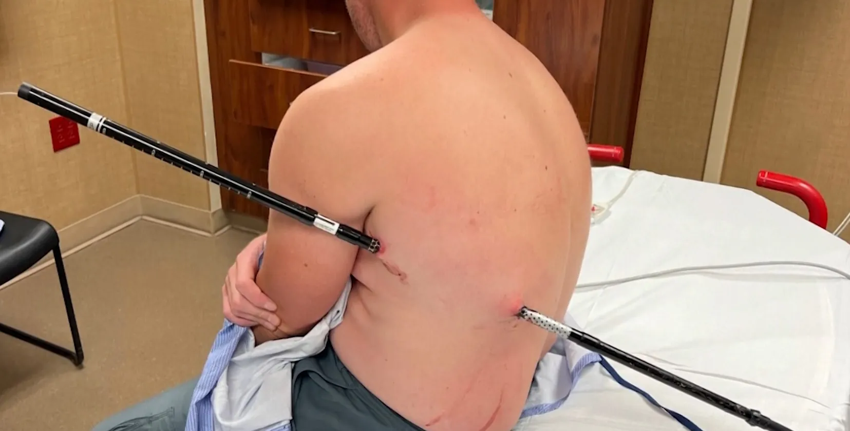 Enfermeiro sofre acidente em trilha e caminha 16 km com bastão atravessado no corpo nos EUA
