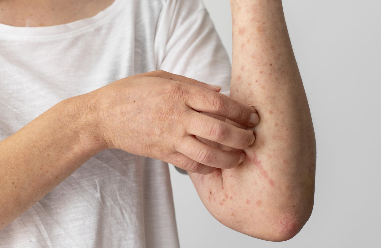 Opas recomenda reforço da vacinação contra sarampo para a Copa do Mundo de 2026