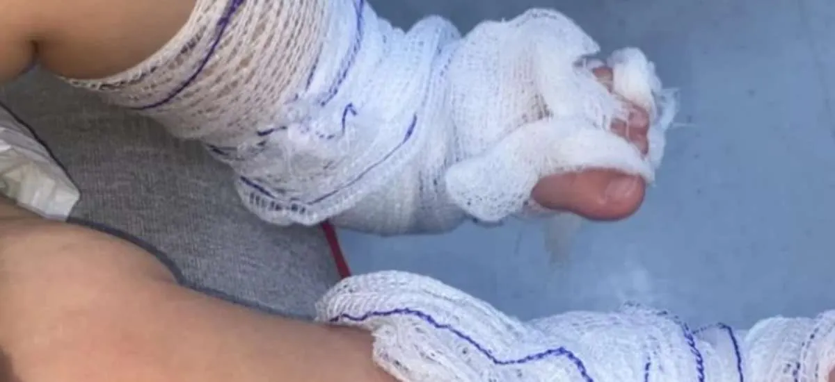 Bebê sofre queimaduras graves após banho em creche