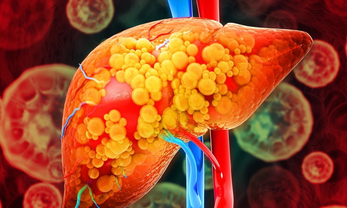 Hepatologista lista os 6 principais sintomas de gordura no fígado