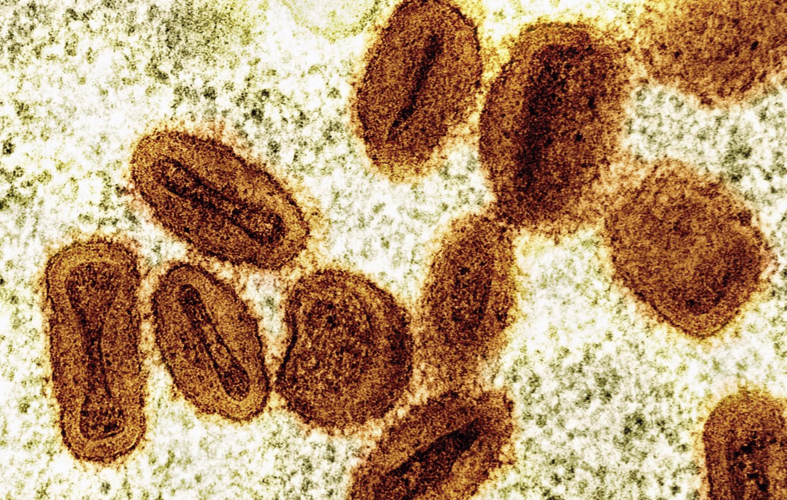 Ceará investiga quatro casos suspeitos de mpox no estado em 2026 | G1