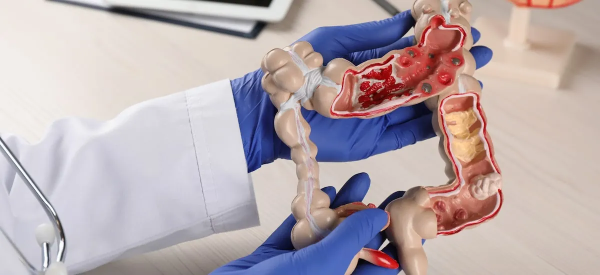 Câncer de intestino: quem deve fazer o teste imunoquímico fecal? Como funciona o exame?