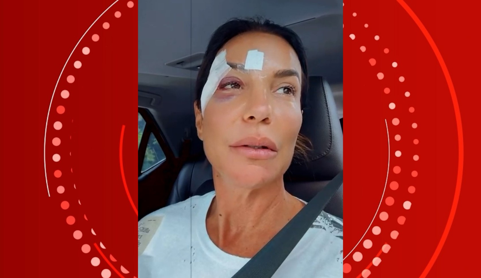 Com olho roxo, Ivete recebe alta de hospital e explica quadro de saúde | G1