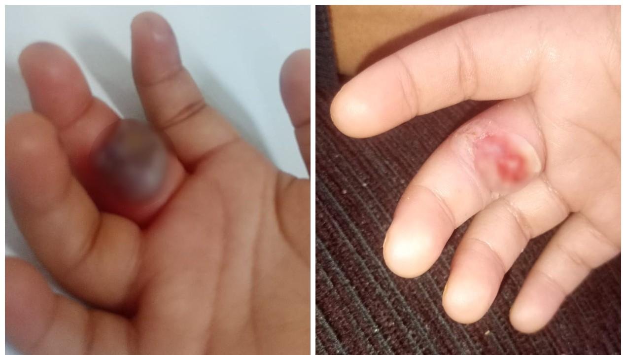 Criança fica ferida após ser picada por aranha em Sorocaba | G1