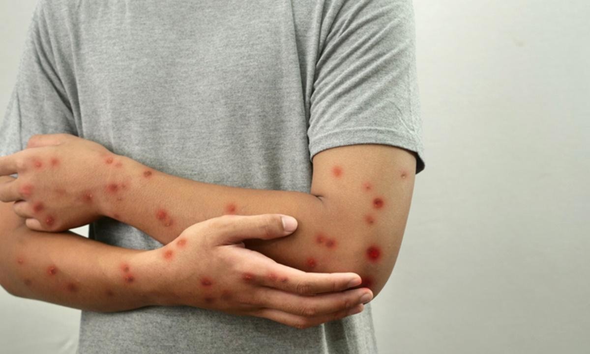 Mpox: DF tem 80 doses da vacina; saiba quem pode receber o imunizante