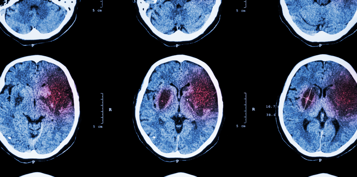 AVC isquêmico ou hemorrágico? A diferença que muda o tratamento