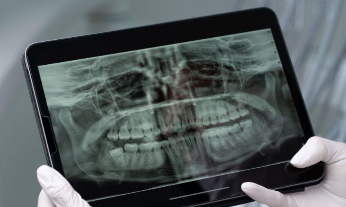 USP: saliva artificial ajuda a proteger dentes de pacientes com câncer